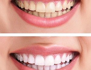 Teeth whitening in Richardson