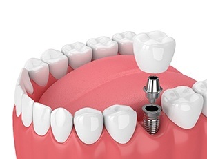 dental implant in Richardson with abutment and crown