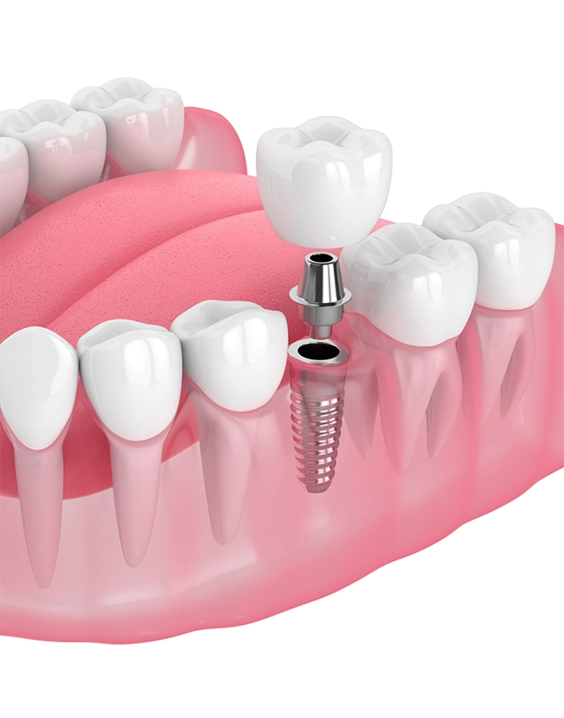 Illustrated dental implant placed in lower jaw