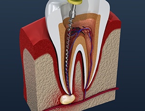 Illustration of root canal therapy in Richardson, TX for single tooth