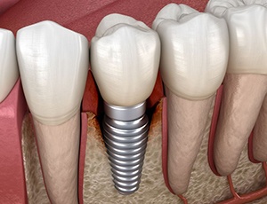 Illustration showing infection around a dental implant