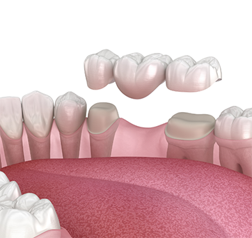 Illustration of a traditional dental bridge