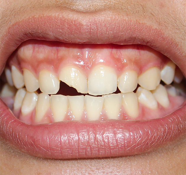 Close up of a chipped front tooth