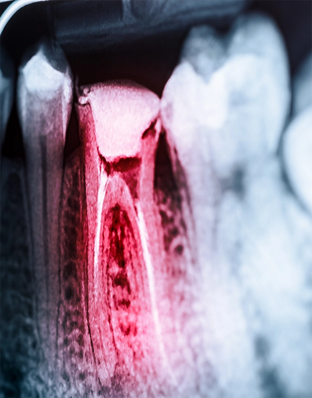 X-ray of an infected tooth