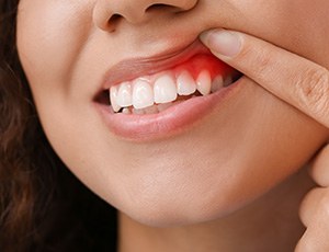 A woman showing her infected gum tissue