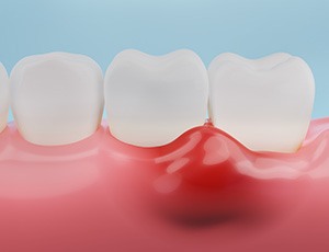 A 3D illustration of infected and inflamed gum tissue