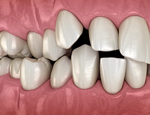 Illustration of spaced out teeth