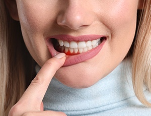 woman pointing to inflamed gums