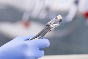 Someone holding a tooth in forceps