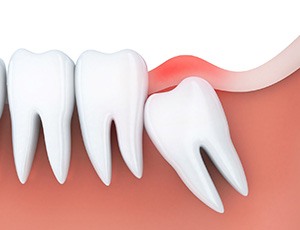 Model of an impacted wisdom tooth