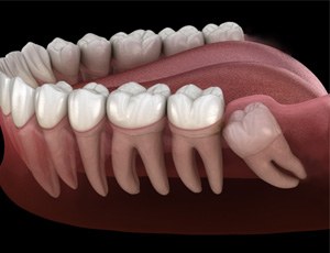 Someone with an impacted wisdom tooth