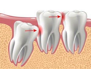 2D image of a wisdom tooth